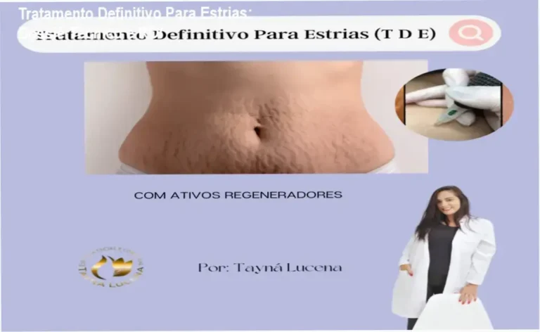 Representação da técnica de regeneração dérmica do Método TDE para redução de estrias